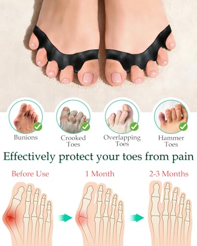 4PCS Silicone Toe Separators to Correct Toes Alignment for Women and Men, Toe Spacers Straightener for Bunion Relief, Hammertoes and Overlapping Toes (Extra Large) - size: Extra Large