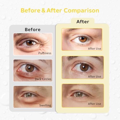 4PCS Gel Eye Ice Pack Set Reusable, Cold and Hot Compress for Eyes - color: Yellow Flowers