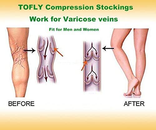 TOFLY Compression Socks For Women & Men Open Toe Knee High 20-30mmHg - color: 20-30mmhg Open-toe Beige, size: Medium