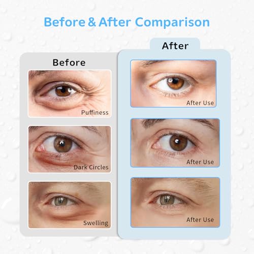 4PCS Gel Eye Ice Pack Set Reusable, Cold and Hot Compress for Eyes - color: Blue Flowers