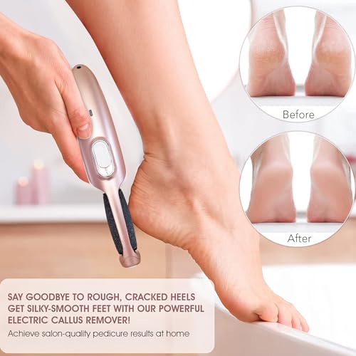 Powerful Electric Callus Remover Wand – Rechargeable Foot File, Grinder Removes Dead, Hard Skin & Calluses for Men & Women – Best Pedicure Tool for Soft, Smooth Feet