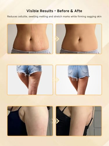 Lymphatic Drainage Massager–Anti-Cellulite,Heat & Microcurrent